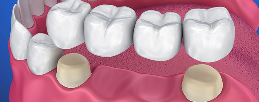 dental-bridge