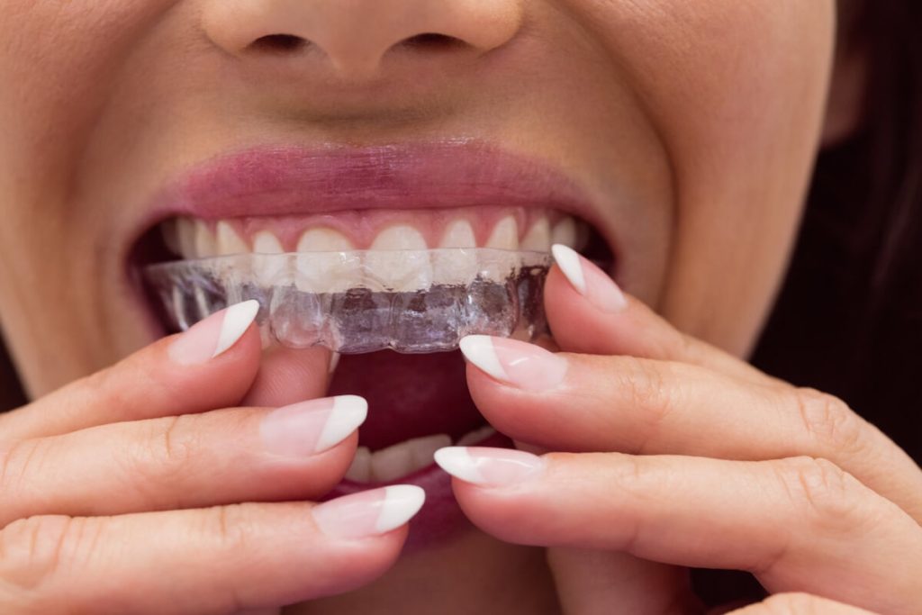 how-to-straighten-your-teeth-braces-and-invisalign-explained-1024x683